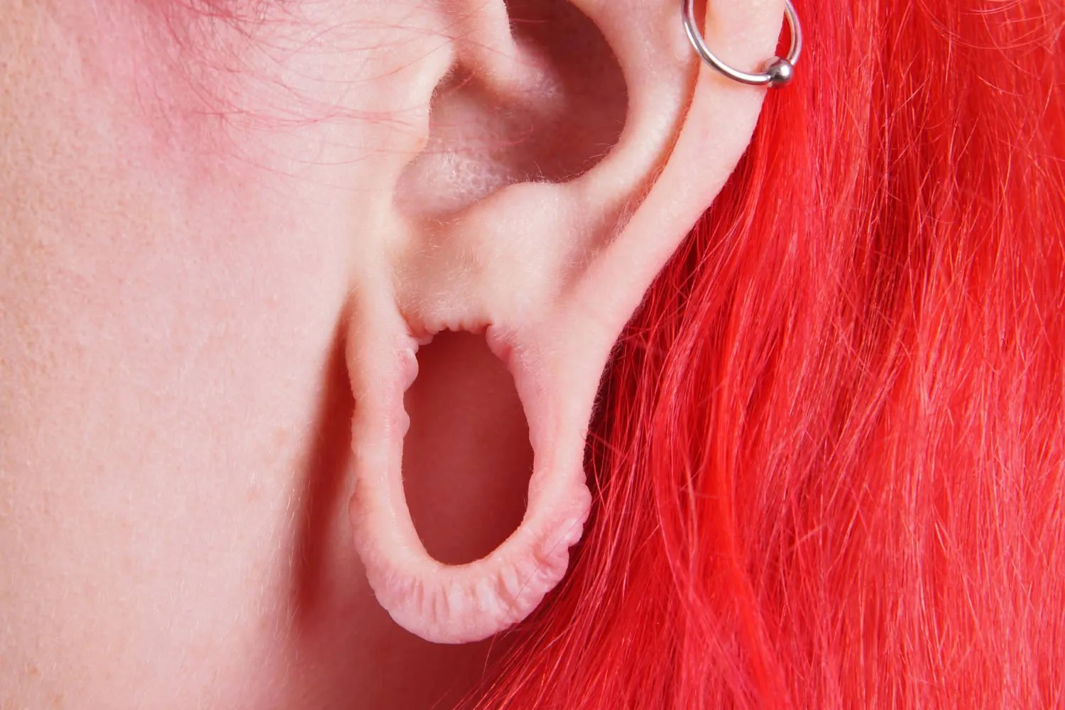 stretched-ear-lobe-repair-dermatologist